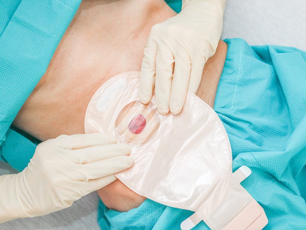 Nurse providing ostomy care at home and teaching a client